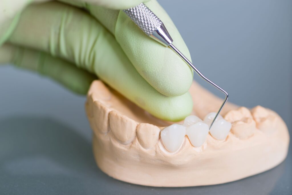 Closeup of hand in green glove poking sample dental bridge with small instrument